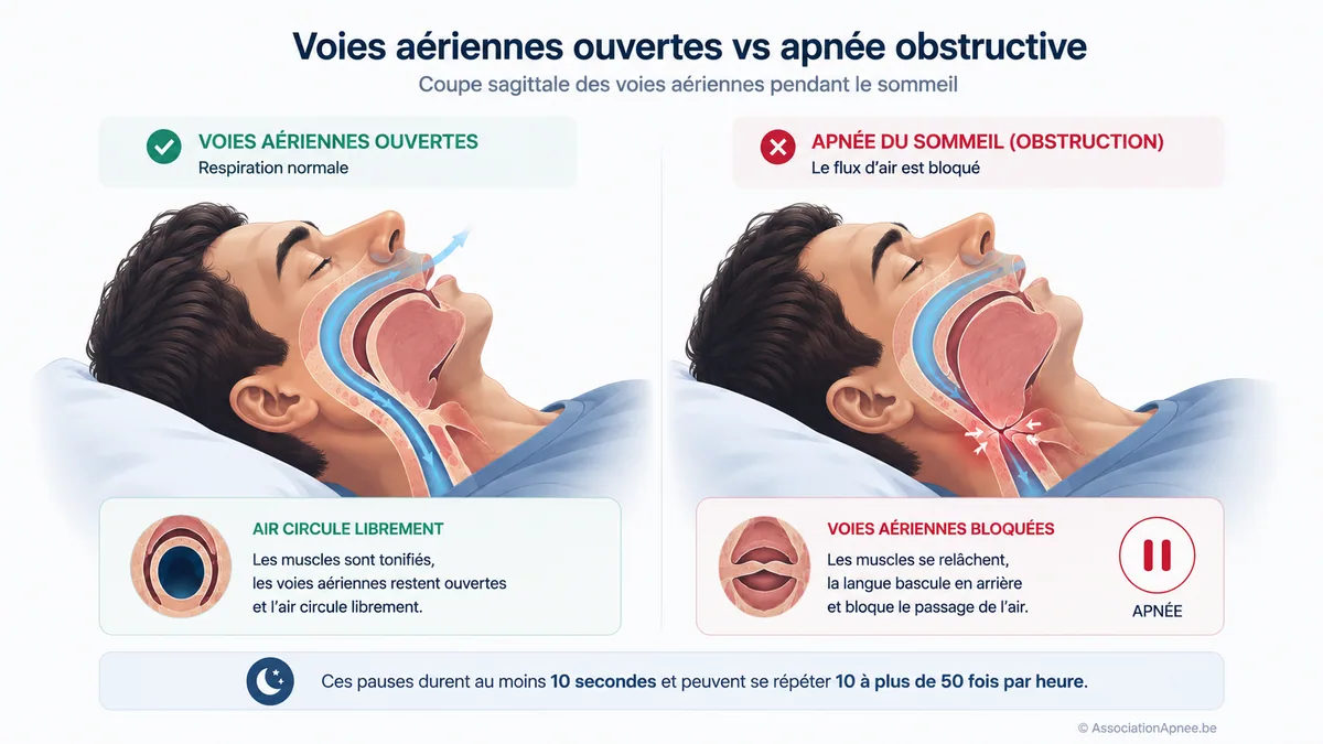 Comparatif anatomique sagittal de deux coupes du pharynx : à gauche les voies aériennes ouvertes pendant une respiration normale, à droite l'obstruction caractéristique de l'apnée obstructive du sommeil avec la langue qui bascule et bloque le passage de l'air